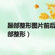 颞部整形图片前后（颞部整形）