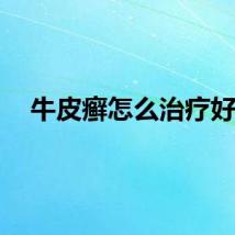 牛皮癣怎么治疗好？