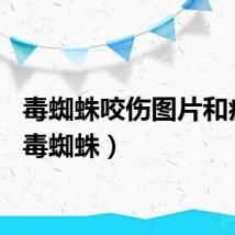 毒蜘蛛咬伤图片和症状（毒蜘蛛）