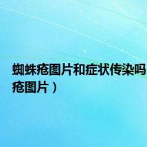 蜘蛛疮图片和症状传染吗(蜘蛛疮图片)