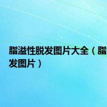 脂溢性脱发图片大全(脂溢性脱发图片)
