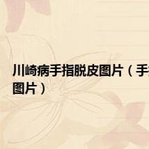 川崎病手指脱皮图片(手指脱皮图片)