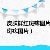 皮肤鲜红斑痣图片（红斑痣图片）