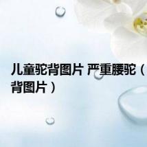 儿童驼背图片 严重腰驼(儿童驼背图片)