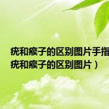 疣和瘊子的区别图片手指瘊子（疣和瘊子的区别图片）