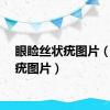 眼睑丝状疣图片（丝状疣图片）