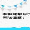 脚趾甲沟炎初期怎么治疗（脚趾甲甲沟炎初期图片）