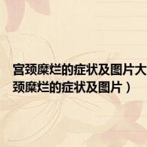 宫颈糜烂的症状及图片大全（宫颈糜烂的症状及图片）