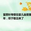 留置针导管在婴儿血管里漂移5年，终于取出来了