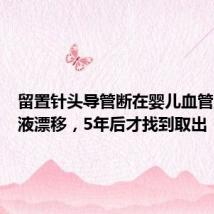 留置针头导管断在婴儿血管里随血液漂移,5年后才找到取出