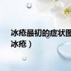 冰疮最初的症状图片（冰疮）