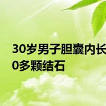 30岁男子胆囊内长满300多颗结石