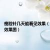 瘦脸针几天能看见效果（瘦脸针效果图）