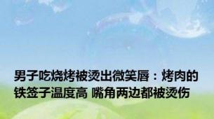 男子吃烧烤被烫出微笑唇：烤肉的铁签子温度高 嘴角两边都被烫伤