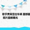 歌手黄霄雲出车祸 面部腿部受伤 照片最新曝光