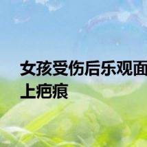 女孩受伤后乐观面对脸上疤痕