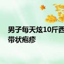 男子每天炫10斤西瓜致带状疱疹