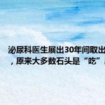 泌尿科医生展出30年间取出的结石,原来大多数石头是“吃”出来