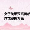 女子美甲致真菌感染治疗花费近万元