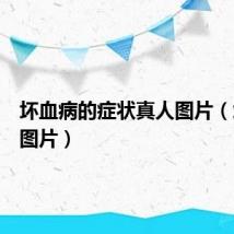 坏血病的症状真人图片（坏血病图片）
