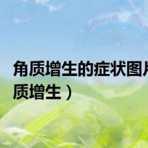 角质增生的症状图片（角质增生）