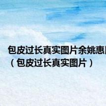 包皮过长真实图片余姚惠民.简介(包皮过长真实图片)