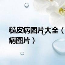 糙皮病图片大全（糙皮病图片）